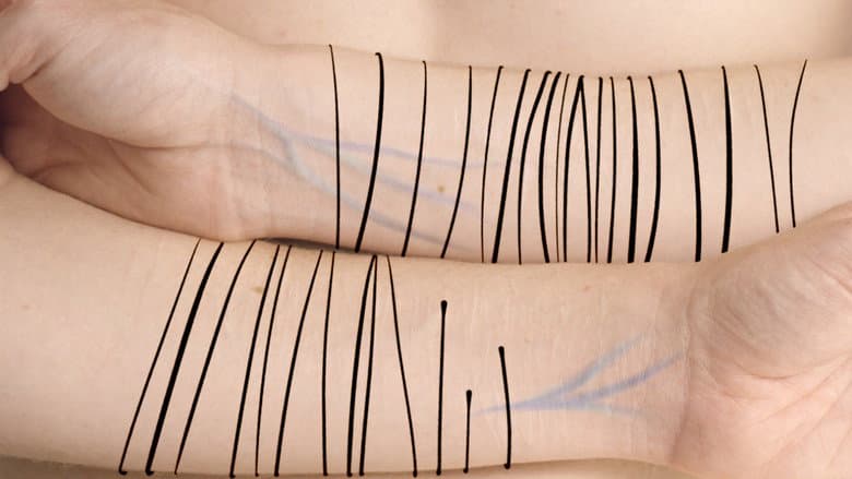 Scars still